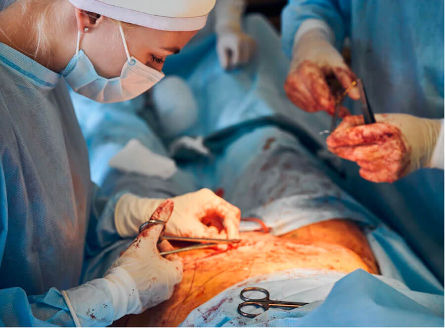 جراحی ابدومینوپلاستی در تهران