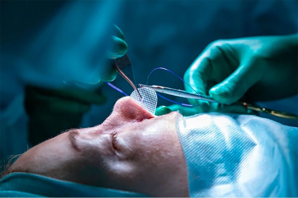 جراحی بینی استخوانی در تهران