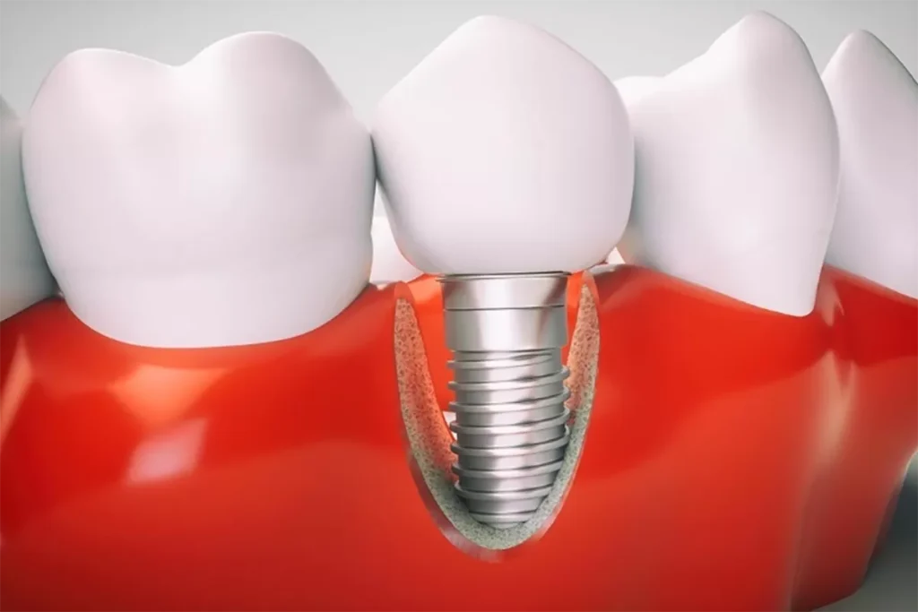 ایمپلنت دندان در کرج